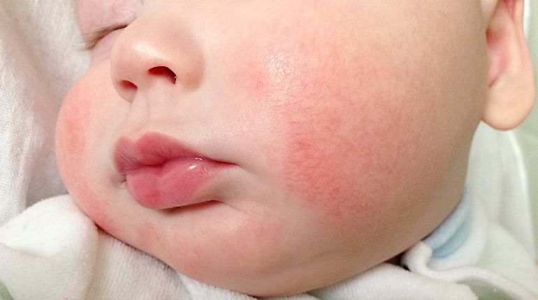 Аллергия у детей