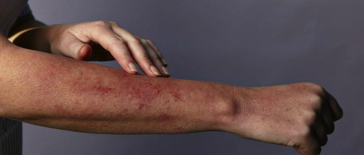 Аллергия на руке